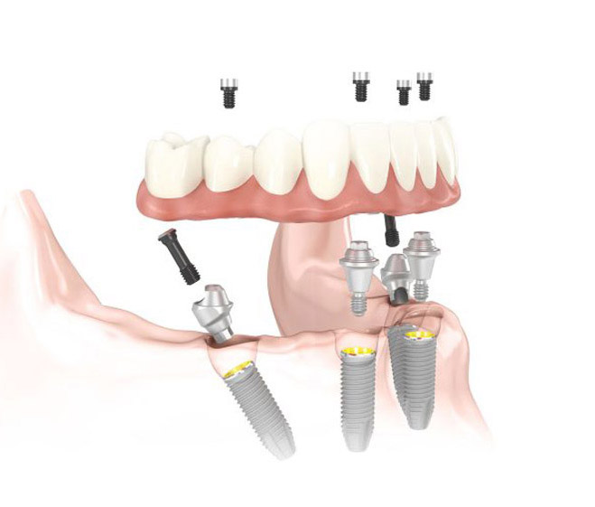 Dental Implants